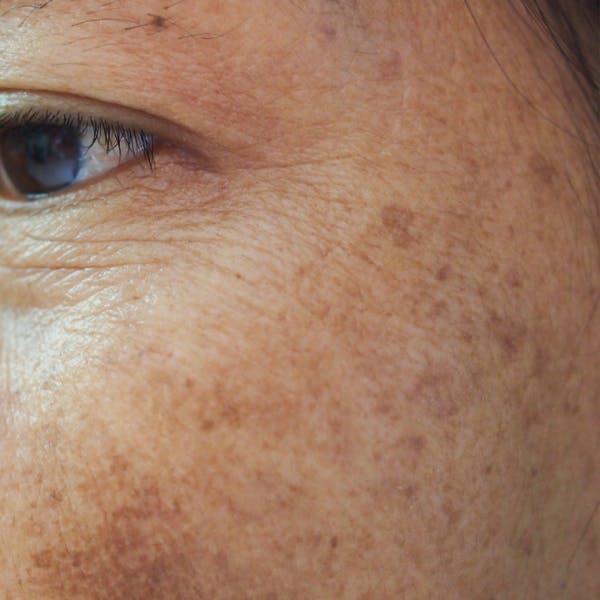 Melasma